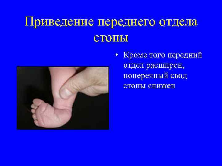 Приведение переднего отдела стопы • Кроме того передний отдел расширен, поперечный свод стопы снижен