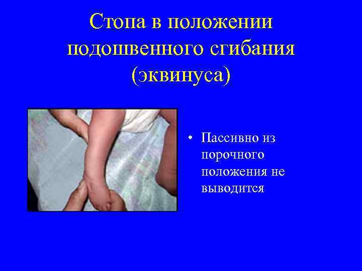 Стопа в положении подошвенного сгибания (эквинуса) • Пассивно из порочного положения не выводится 