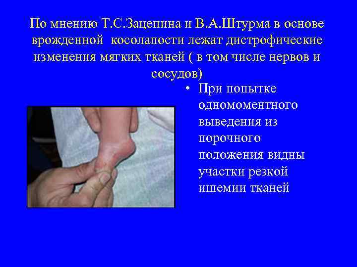 По мнению Т. С. Зацепина и В. А. Штурма в основе врожденной косолапости лежат