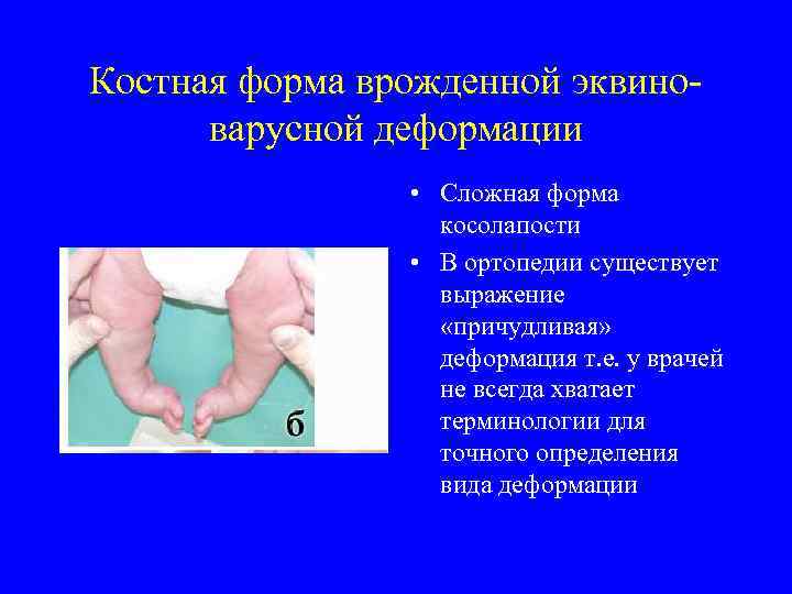 Костная форма врожденной эквиноварусной деформации • Сложная форма косолапости • В ортопедии существует выражение
