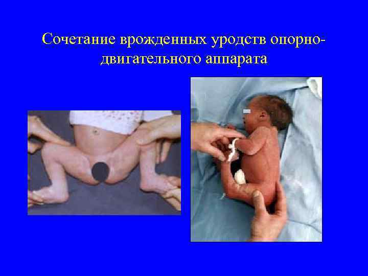 Сочетание врожденных уродств опорнодвигательного аппарата 