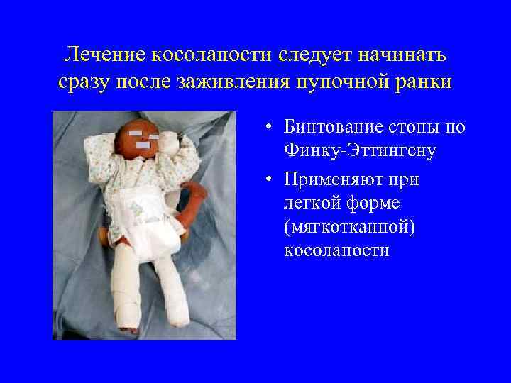 Лечение косолапости следует начинать сразу после заживления пупочной ранки • Бинтование стопы по Финку-Эттингену