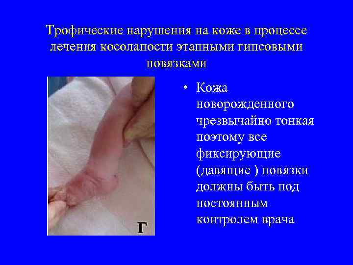 Трофические нарушения на коже в процессе лечения косолапости этапными гипсовыми повязками • Кожа новорожденного