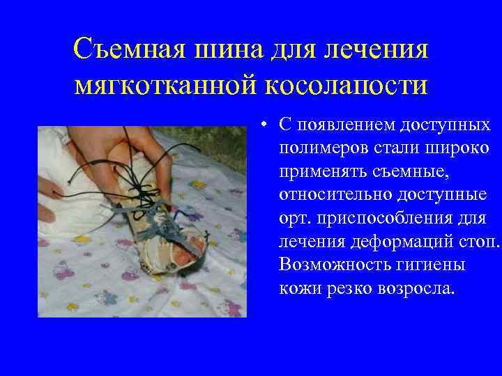 Съемная шина для лечения мягкотканной косолапости • С появлением доступных полимеров стали широко применять