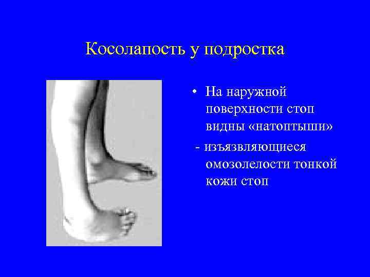 Косолапость у подростка • На наружной поверхности стоп видны «натоптыши» - изъязвляющиеся омозолелости тонкой