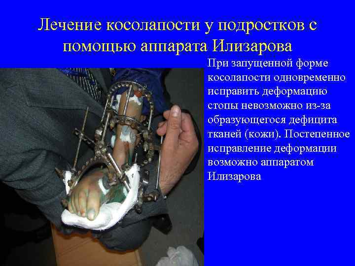 Лечение косолапости у подростков с помощью аппарата Илизарова При запущенной форме косолапости одновременно исправить