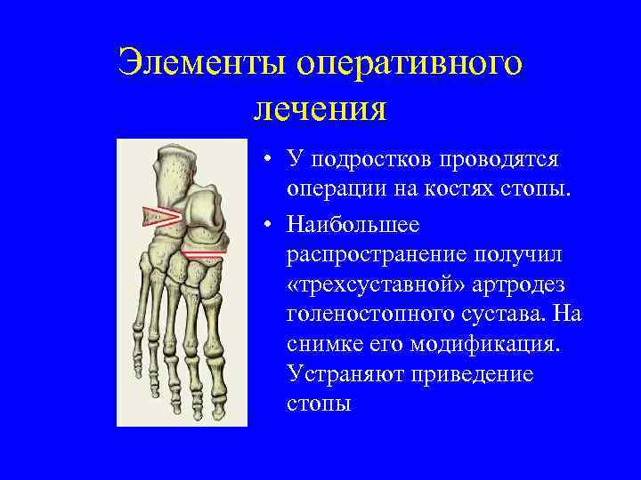 Элементы оперативного лечения • У подростков проводятся операции на костях стопы. • Наибольшее распространение