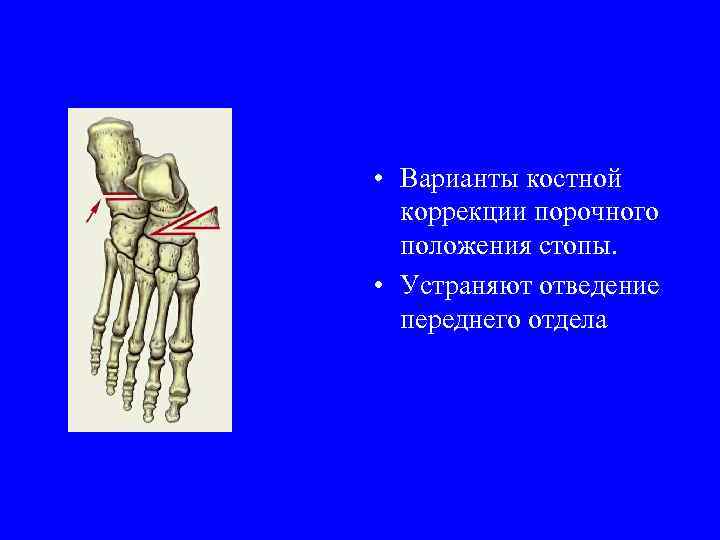  • Варианты костной коррекции порочного положения стопы. • Устраняют отведение переднего отдела 