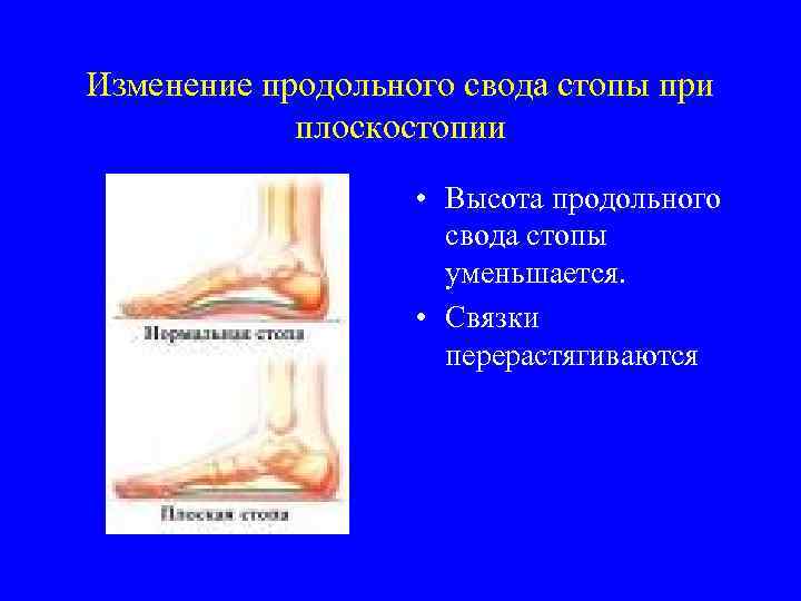 Изменение продольного свода стопы при плоскостопии • Высота продольного свода стопы уменьшается. • Связки