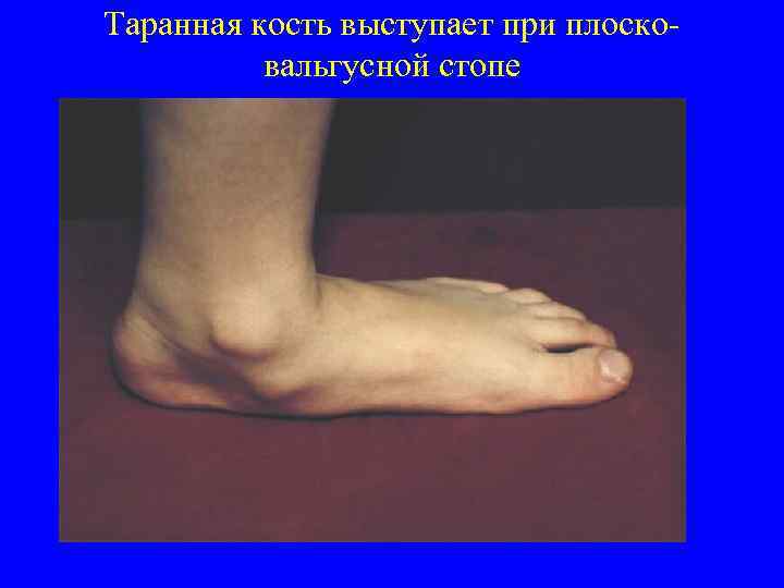Таранная кость выступает при плосковальгусной стопе 