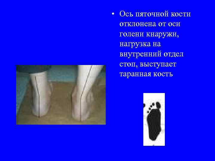  • Ось пяточной кости отклонена от оси голени кнаружи, нагрузка на внутренний отдел