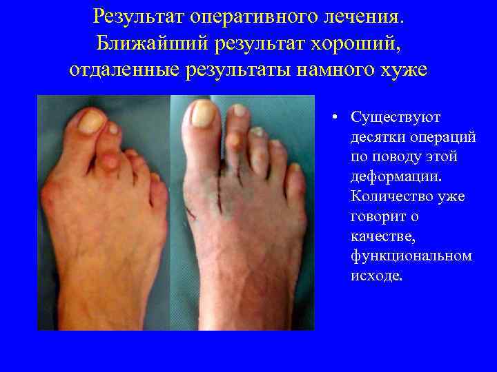 Результат оперативного лечения. Ближайший результат хороший, отдаленные результаты намного хуже • Существуют десятки операций