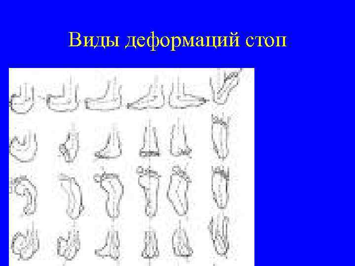 Виды деформаций стоп 