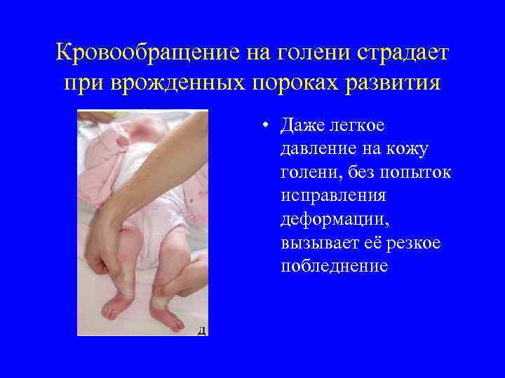 Кровообращение на голени страдает при врожденных пороках развития • Даже легкое давление на кожу
