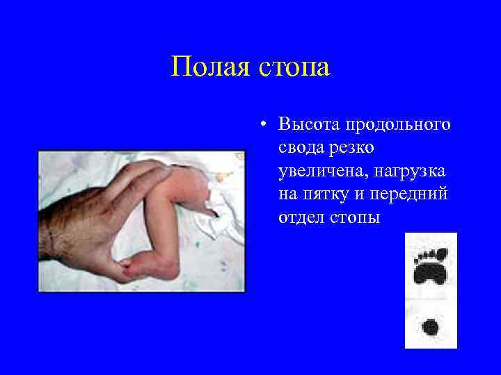 Полая стопа • Высота продольного свода резко увеличена, нагрузка на пятку и передний отдел