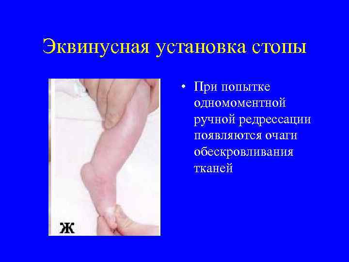 Эквинусная установка стопы • При попытке одномоментной ручной редрессации появляются очаги обескровливания тканей 