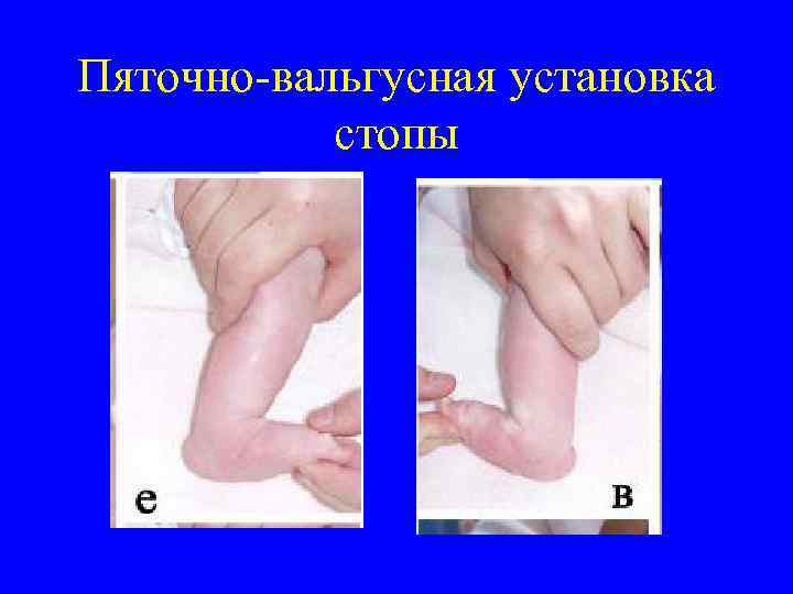 Пяточно-вальгусная установка стопы 