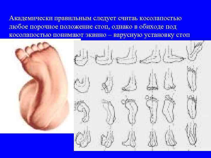 Академически правильным следует считаь косолапостью любое порочное положение стоп, однако в обиходе под косолапостью