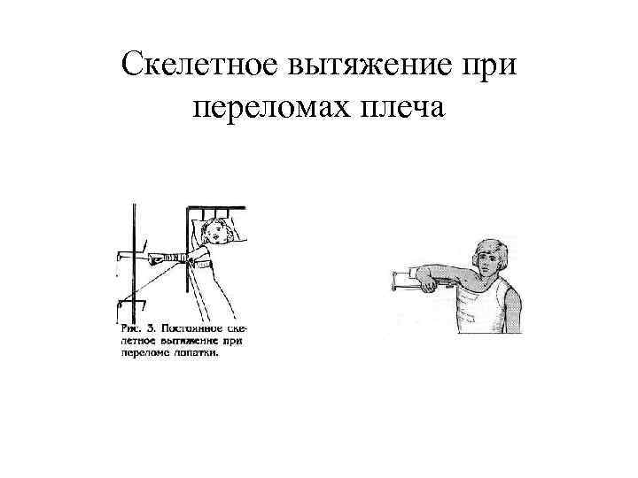 Переломы верхней конечности презентация