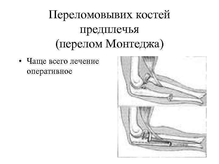 Перелом костей предплечья. Сгибательный перелом Монтеджи. Перелом вывих Монтеджа. Вправление перелома Монтеджи.