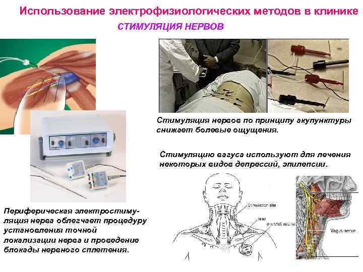 Использование электрофизиологических методов в клинике СТИМУЛЯЦИЯ НЕРВОВ Стимуляция нервов по принципу акупунктуры снижает болевые