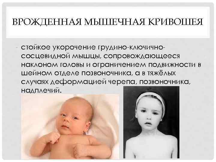 ВРОЖДЕННАЯ МЫШЕЧНАЯ КРИВОШЕЯ стойкое укорочение грудино ключично сосцевидной мышцы, сопровождающееся наклоном головы и ограничением
