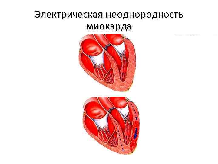 Электрическая неоднородность миокарда 