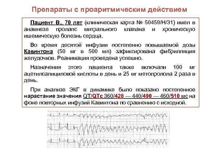 Препараты с проаритмическим действием Пациент В. , 70 лет (клиническая карта № 50459/Н/31) имел
