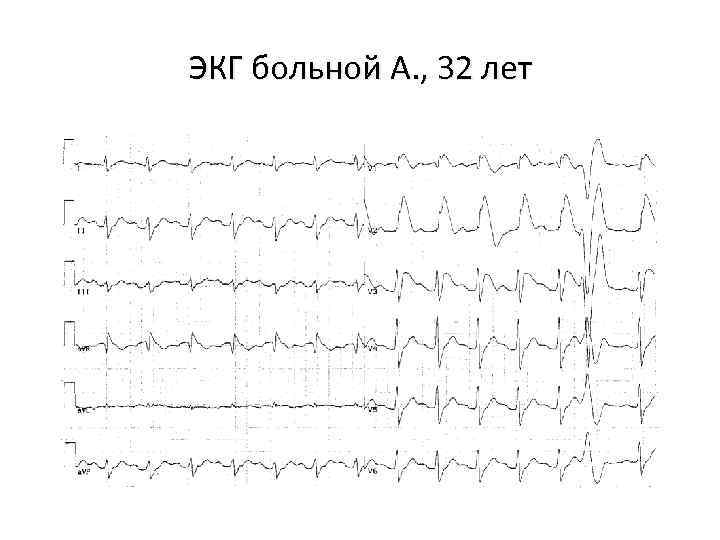 ЭКГ больной А. , 32 лет 