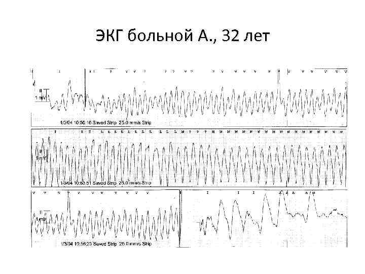 ЭКГ больной А. , 32 лет 