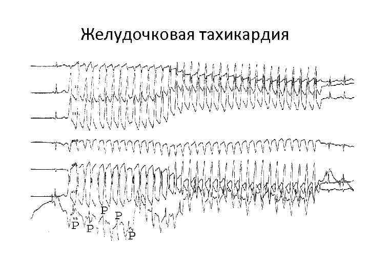 Желудочковая тахикардия 
