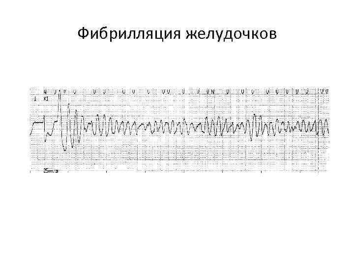 Фибрилляция желудочков 