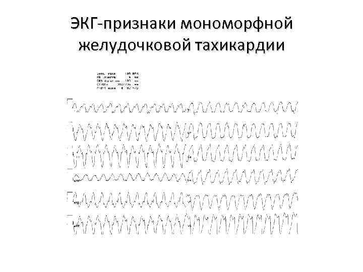 ЭКГ-признаки мономорфной желудочковой тахикардии 