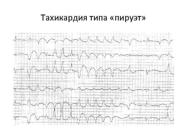 Тахикардия типа «пируэт» 
