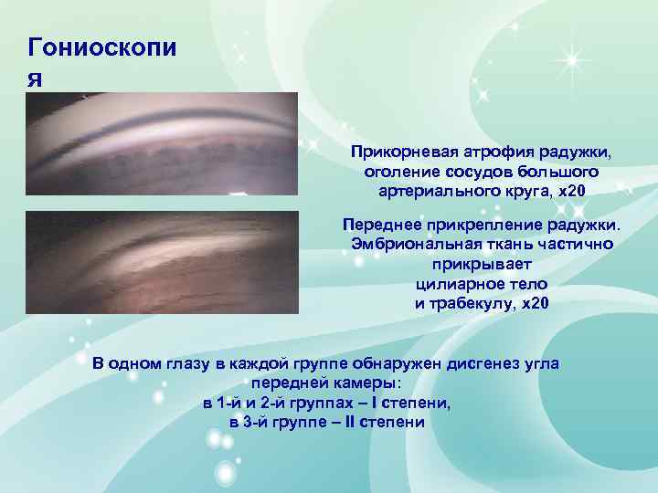 Гониоскопи я Прикорневая атрофия радужки, оголение сосудов большого артериального круга, х20 Переднее прикрепление радужки.