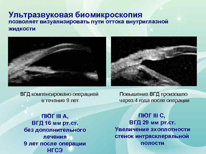 Ультразвуковая биомикроскопия позволяет визуализировать пути оттока внутриглазной жидкости ВГД компенсировано операцией в течение 9