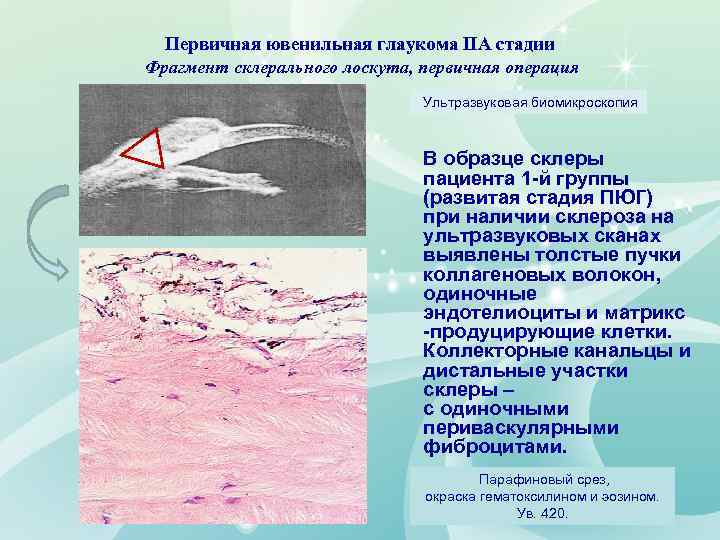 Первичная ювенильная глаукома IIА стадии Фрагмент склерального лоскута, первичная операция Ультразвуковая биомикроскопия В образце