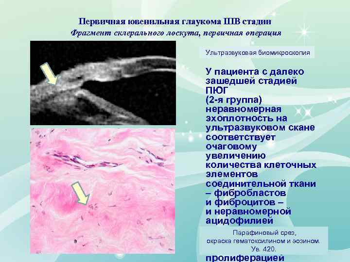 Первичная ювенильная глаукома IIIВ стадии Фрагмент склерального лоскута, первичная операция Ультразвуковая биомикроскопия У пациента
