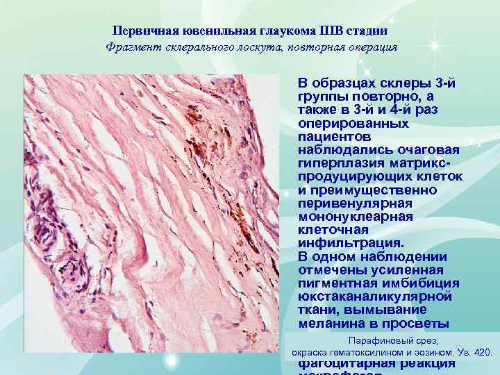 Первичная ювенильная глаукома IIIВ стадии Фрагмент склерального лоскута, повторная операция В образцах склеры 3