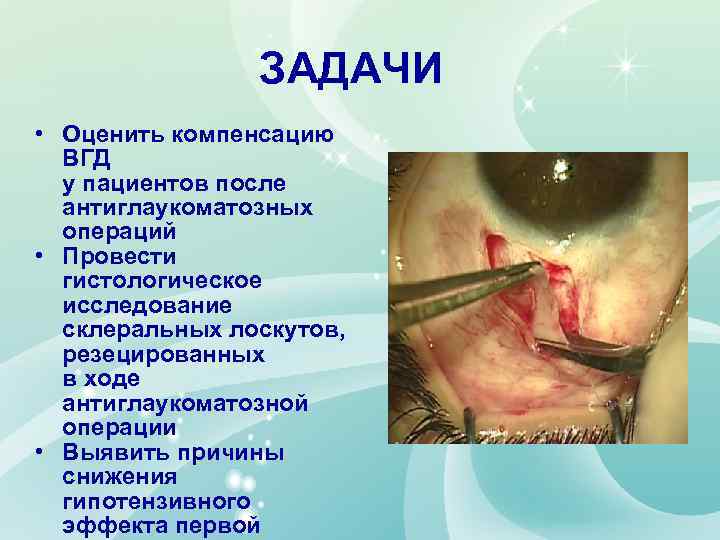 ЗАДАЧИ • Оценить компенсацию ВГД у пациентов после антиглаукоматозных операций • Провести гистологическое исследование