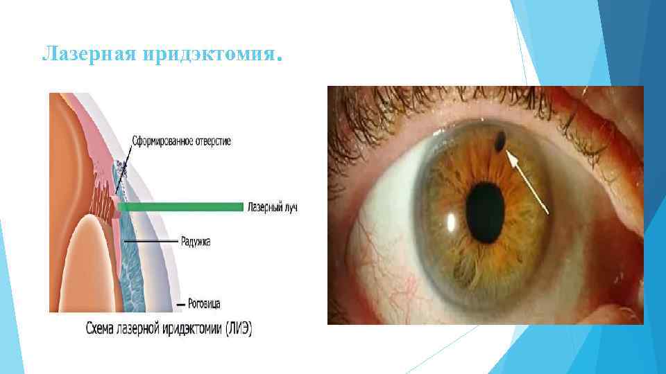 Лазерная иридэктомия. 