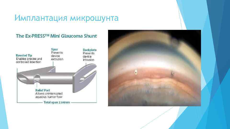 Имплантация микрошунта 