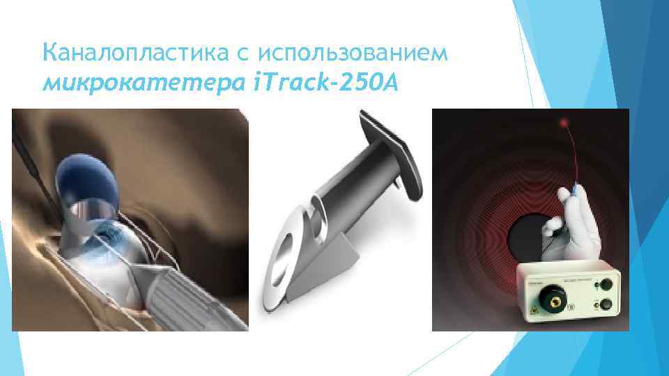 Каналопластика с использованием микрокатетера i. Track-250 A 