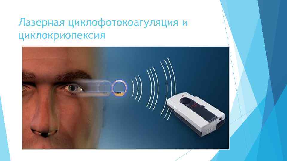 Лазерная циклофотокоагуляция и циклокриопексия 