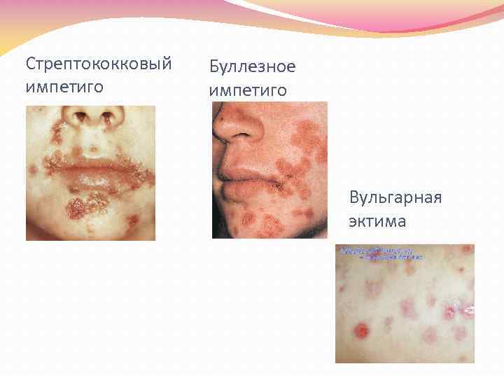 Стрептококковый импетиго Буллезное импетиго Вульгарная эктима 