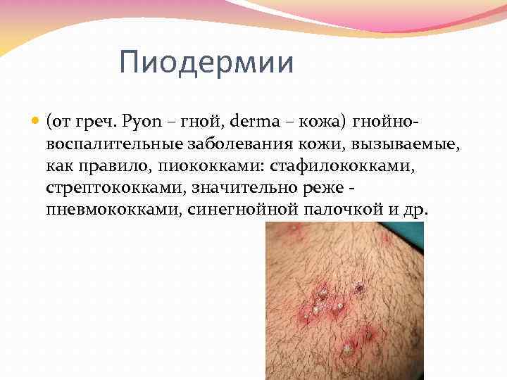Пиодермии (от греч. Pyon – гной, derma – кожа) гнойно воспалительные заболевания кожи, вызываемые,