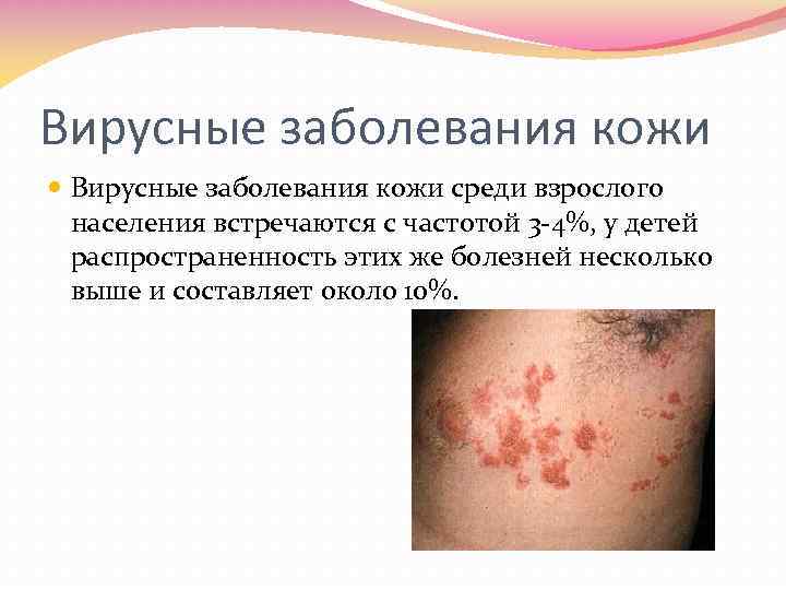 Вирусные заболевания кожи среди взрослого населения встречаются с частотой 3 4%, у детей распространенность