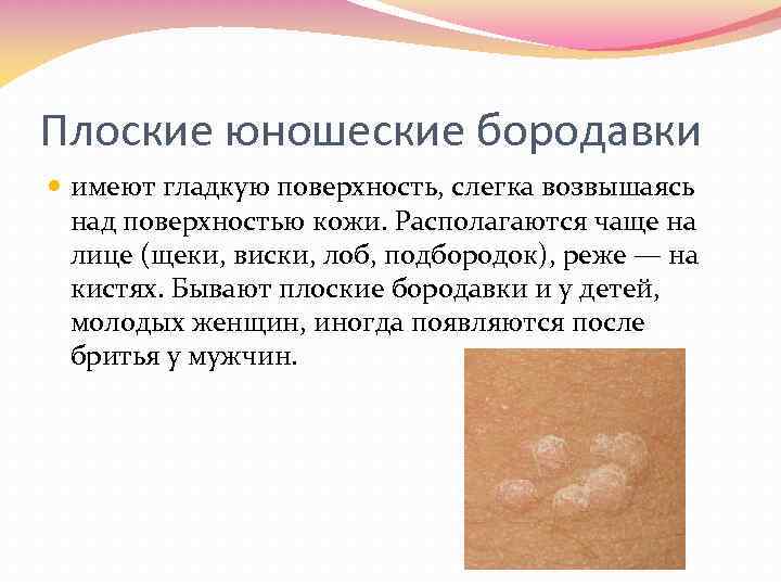Плоские юношеские бородавки имеют гладкую поверхность, слегка возвышаясь над поверхностью кожи. Располагаются чаще на