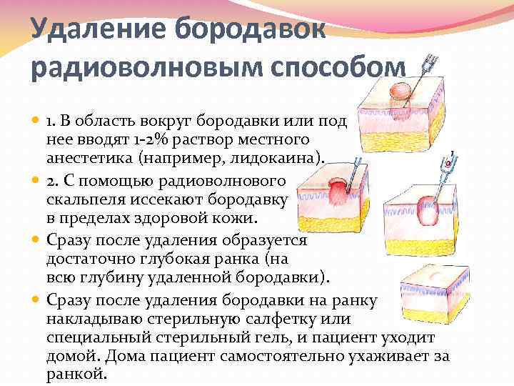 Удаление бородавок радиоволновым способом 1. В область вокруг бородавки или под нее вводят 1