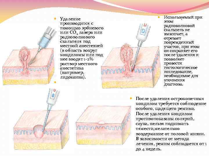  Удаление производится с помощью эрбиевого или CO 2 лазера или радиоволнового скальпеля под